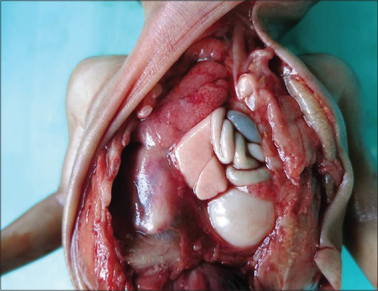 Congenital diaphragmatic hernia. The left hemithorax contains loops of small intestine and stomach pushing the heart and left lung to the right side