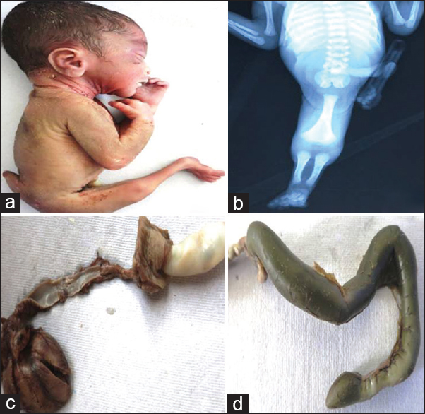 Mermaid fetus; (a) single median lower limb with pseudo tail in the lumbosacral region, (b) fetogram shows fused pelvic bones, single femur, and absent fibula, (c) hypoplastic descending abdominal aorta continuing as single umbilical artery, (d) meconium filled, blind-ended colon