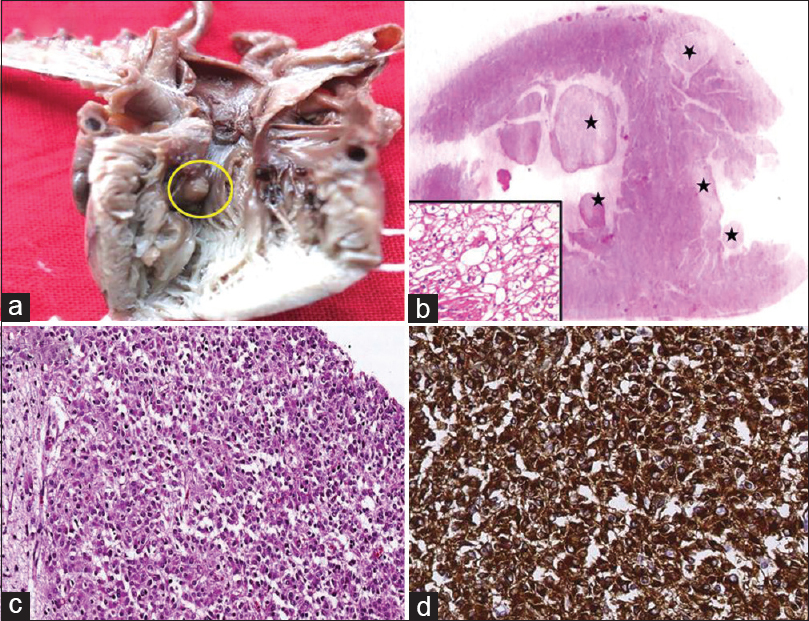 Tuberous sclerosis complex: (a) fleshy, pale brown mass in the left ventricular outflow tract, (b) transverse section of the heart shows multiple paler nodules(*) in subendocardial and intramural location. Inset shows high-power view of the nodule consisting of large vacuolated cells-rhabdomyoma (H and E, ×400), (c) section from medulla shows large subependymal plaque consisting of a cellular admixture of glial cells (H and E, ×100) and (d) these cells strongly express GFAP (IHC, ×400)