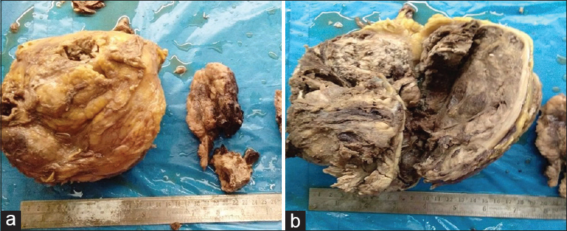 (a and b) Grossly, the kidney was enlarged and distorted and the cut section showed a tumor replacing almost whole of the renal parenchyma measuring 20 cm × 14 cm × 9 cm, involving the renal pelvis and sinus. The tumor was friable, grayish-brown with areas of necrosis and hemorrhage