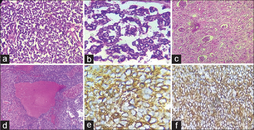 (a) Section showing monomorphic cells with small round nuclei and fine chromatin and inconspicuous nucleoli (H and E, ×200); (b) tumor cells arranged in pseudorosettes (H and E, ×400); (c) section showing normal renal parenchyma (H and E, ×200); (d) section showing tumor with extensive hemorrhage (H and E, ×100); (e and f) figures showing positivity of tumor cells for CD99 and vimentin (e: CD99, ×400 and f: vimentin, ×200)