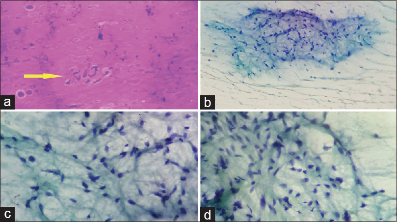 (a and b) Hypocellular fragments of spindle and stellate cells with oval to spindle nuclei in abundant myxoid material in background (Giemsa, ×40, Papanicolaou, ×10) (c and d) Oval to spindle nuclei have evenly dispersed, fine chromatin, thin nuclear membrane, and inconspicuous nucleoli with focal mild nuclear pleomorphism and thin delicate vascular cores (Papanicolaou, ×40)