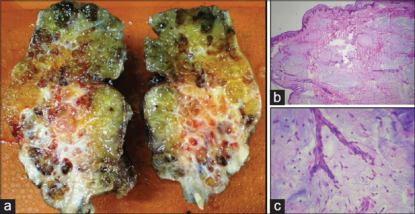 (a) Cut surface of cheek mass shows circumscribed, nodular, solid-cystic mass showing gelatinous and hemorrhagic areas. (b) Tumor in the dermis and subcutaneous plane is composed of multiple hypocellular nodules with abundant myxoid stroma and spindle to stellate cells within it. Focally increased cellularity is seen (H and E, ×4) (c) small proliferating blood vessels with stellate cells and myxoid stroma in the background (H and E, ×40)