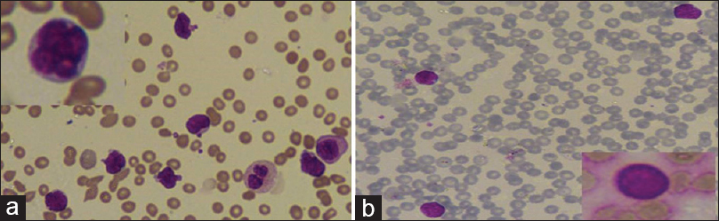 (a) Lymphobalsts with L2 morphology and many convolutions (Giemsa, ×400). Inset: a lymphoblast with flower-like convolutions. (b) Lymphoblasts with L1 morphology and absent convolutions (Giemsa, ×400). Inset: lymphoblast with absent convolutions