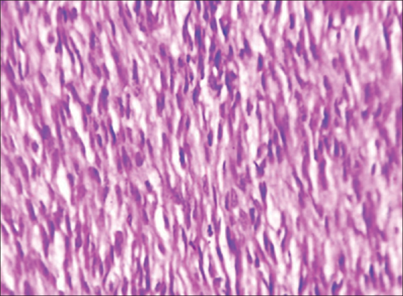 Photomicrograph showing histology of congenital mesoblastic nephroma (×100)