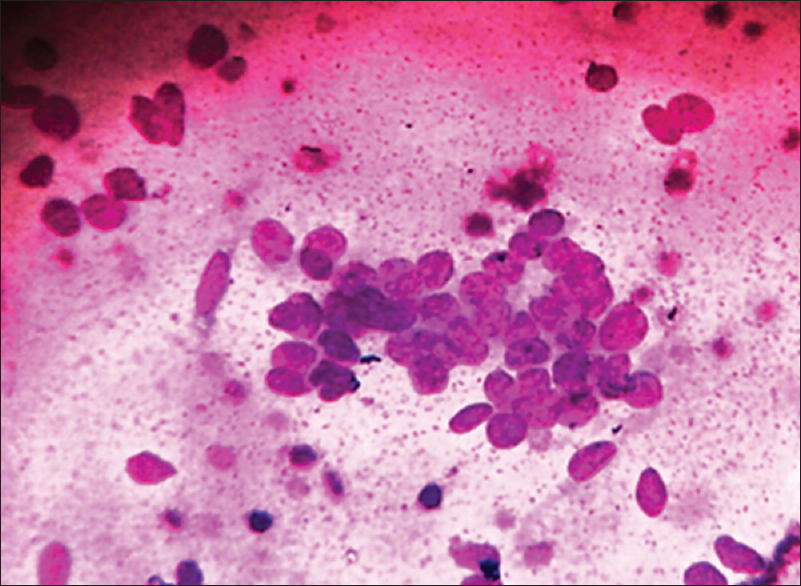 Imprint cytology of blastemal cells in Wilms tumour (×400)