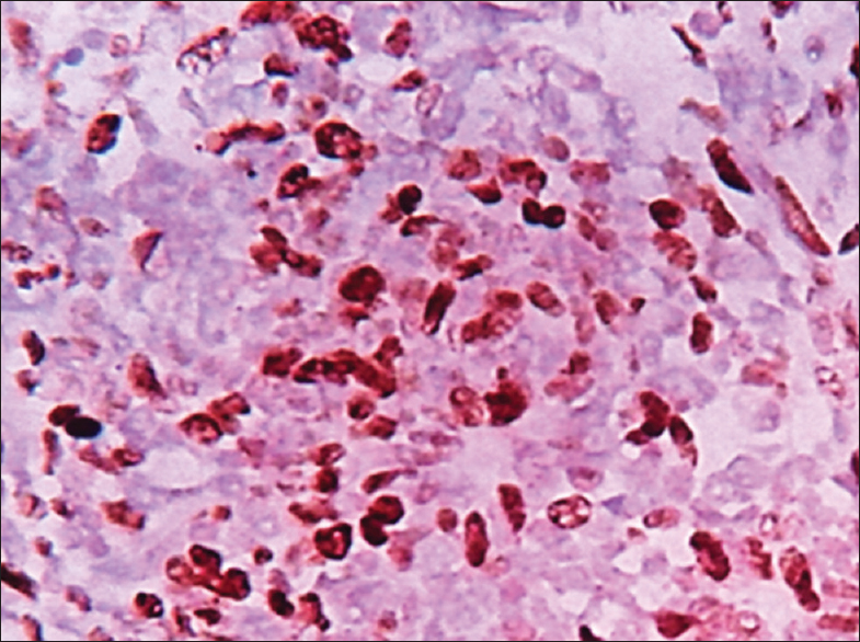 Ki67-positive cells in blastemal cells (×400)