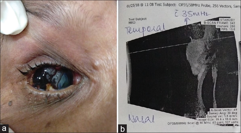 (a and b) A pigmented and elevated lesion measuring approximately 0.8 cm × 0.8 cm, in the right eye encroaching over conjunctiva and cornea along with hazy corneal opacity, suggestive of cataract. (b) B-mode ultrasound revealed an eyelid and conjunctival lesion (? melanoma) with encroachment on cornea of the right eye
