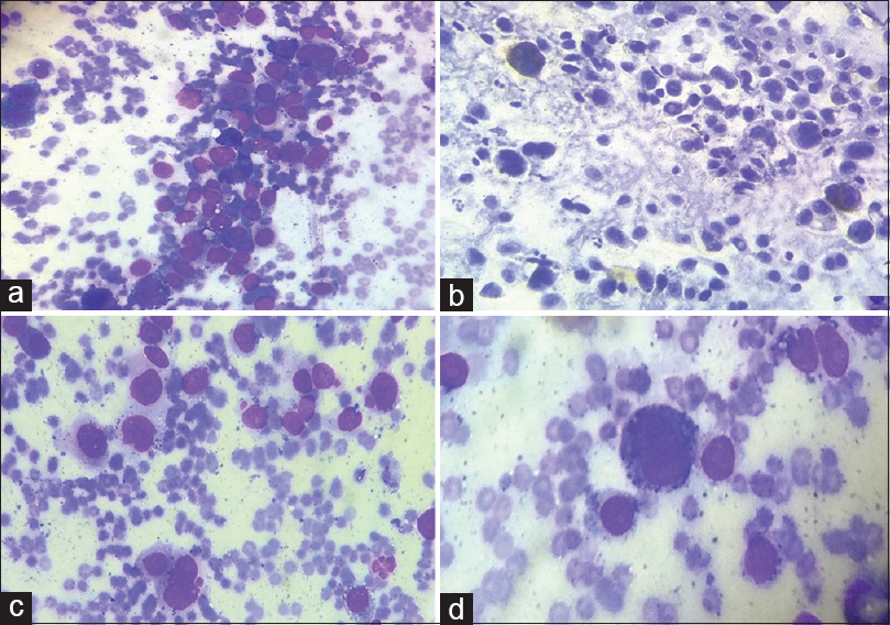 (a-d) Fine-needle aspiration smears from the ocular lesion revealing high cellularity and composed of predominantly singly scattered tumor cells along with few groups and clusters showing moderate pleomorphism (a and b) with round to oval to spindled-shaped cells with central to eccentrically placed nuclei, coarse chromatin, prominent inclusion-like nucleoli (d) and moderate amount of cytoplasm. Many binucleated, multinucleated, and bizarre forms (a-d) are noted along with intracellular and extracellular blackish brown pigment (melanin) (a: Giemsa, ×200; b: Pap, ×200, c: Giemsa, ×400, d: Giemsa, ×1000)