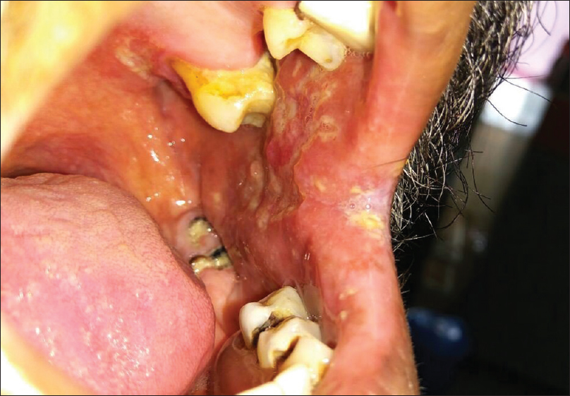 Ulcer in the right buccal mucosa extending to the right labial mucosa