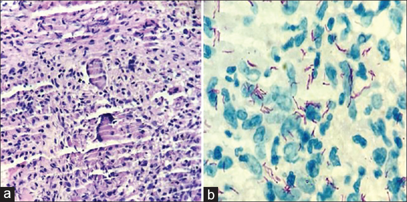 (a) Biopsy from the edge of the oral ulcer showed caseous epithelioid cell granulomas (H and E, ×100). (b) Biopsy showing acid-fast positive bacilli (ZN Stain, ×1000)