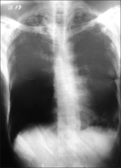 Chest X-ray showed cavitary changes in bilateral upper lungs with tree-in-bud nodules and patchy consolidation