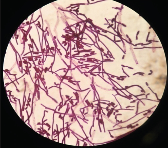 Grams stain of the colony showing hyphal forms with arthrospores and few budding yeast cells