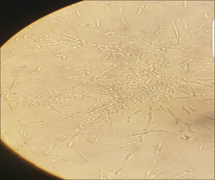 Corn meal agar showing pseudohyphae with blastoconidia of varying sizes and rectangular arthroconidia