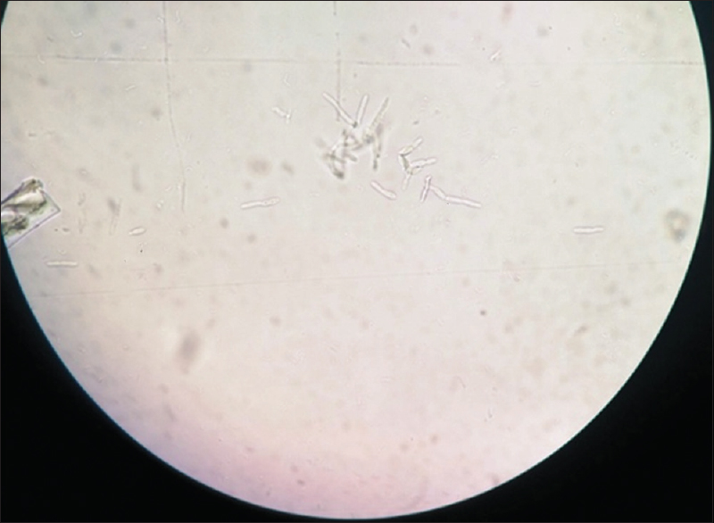 Wet mount of urine showing budding yeast cells, pseudohyphae and true hyphal forms
