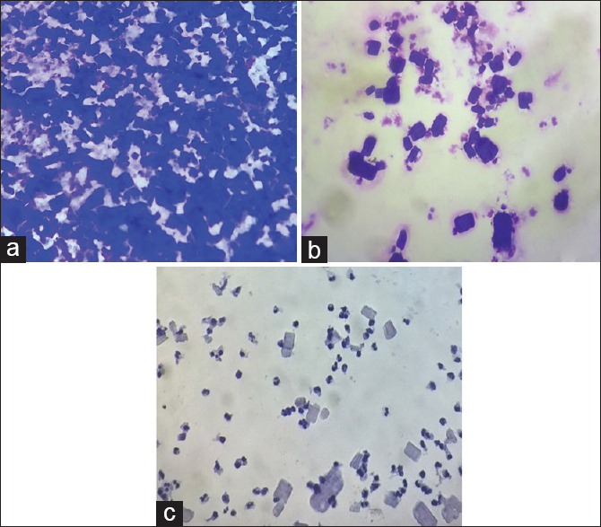 (a-c) Smears showing mainly acute and chronic inflammatory cells mixed with numerous crystalloids which were rectangular to rhomboid in shape with long parallel sides, some with pointed ends, suggestive of amylase crystals