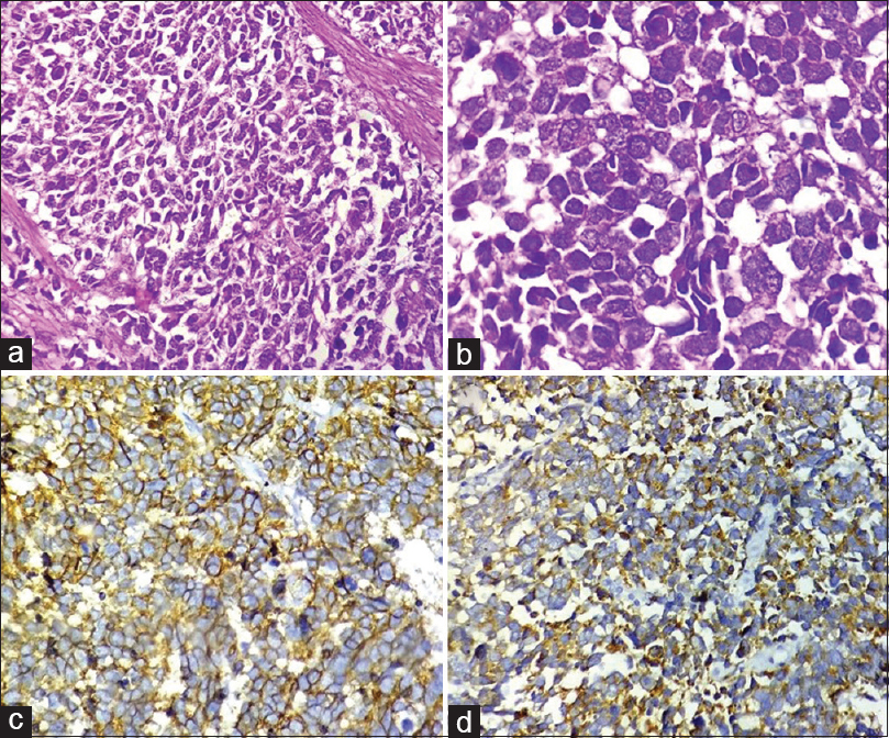 (a) Section showing a highly cellular tumor arranged in sheets and composed of small cells with high nuclear-cytoplasmic ratio (H and E, ×400). (b) High power view of tumor cells revealing scant cytoplasm, pleomorphic, angulated and hyperchromatic nuclei, finely granular chromatin, and inconspicuous nucleoli (H and E, ×1000). (c and d) Tumor cells showing positivity for CD56 (c, ×400) and synaptophysin (d, ×400)