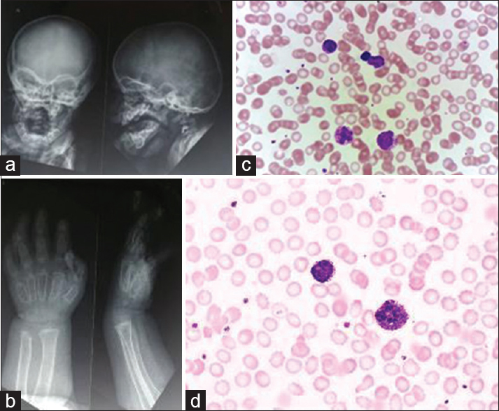 (a) The X-ray skull shows thickening of skull bones and “J-” shaped sella turcica. (b) Tapering of proximal metacarpals were found on the X-ray of Hands. (c and d) The photomicrograph shows neutrophils and lymphocytes showing Alder–Reilly anomaly. The Red blood cells series and platelets were morphologically unremarkable (Wright–Giemsa, ×1000)
