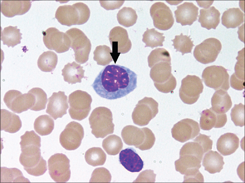 Peripheral blood film showing a plasmacytoid lymphocyte having intensely basophilic cytoplasm, moderate nucleocytoplasmic ratio, and eccentric nuclei (Leishman stain, ×1000)