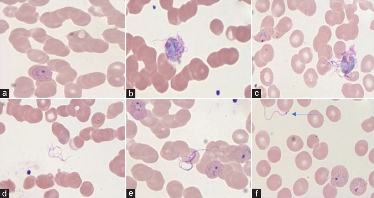 (a) Trophozoite of Plasmodium vivax (×1000; Leishman). (b and c) Exflagellation of microgametes from microgametocytes (×1000; Leishman). (d-f) Exflagellated microgametes (×1000; Leishman)