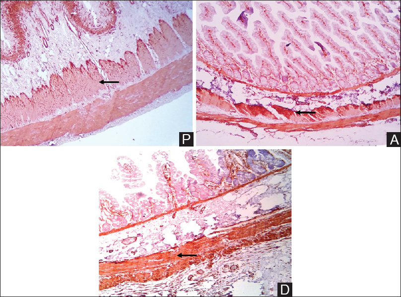 Immunohistochemistry with alpha-smooth muscle actin shows proximal segment with circular smooth muscle hypertrophy and decreased intensity of alpha-smooth muscle actin staining as compared with the distal segment (Arrow) (P = Proximal segment, A = Atretic segment, D = Distal segment. Alpha-smooth muscle actin immunohistochemical, scanner view ×40)