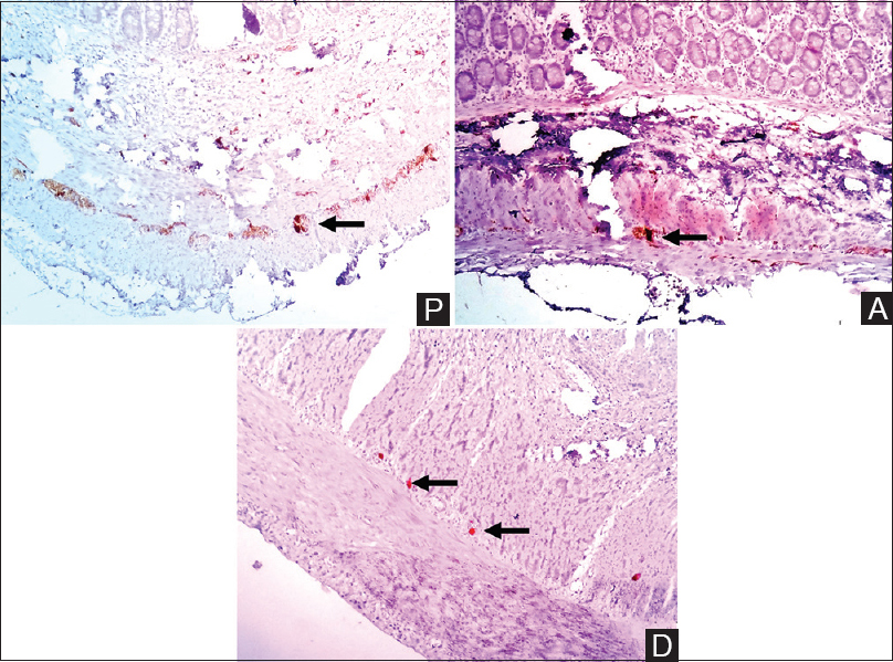 Immunohistochemistry with calretinin shows mature ganglion cell cytoplasm and the surrounding nerve fibers. Distal segment and atretic segment showed reduced number and intensity of ganglion cells as compared with the proximal segment (Arrow) (P = Proximal segment, A = Atretic segment, D = Distal segment, calretinin IHC, scanner view ×40)