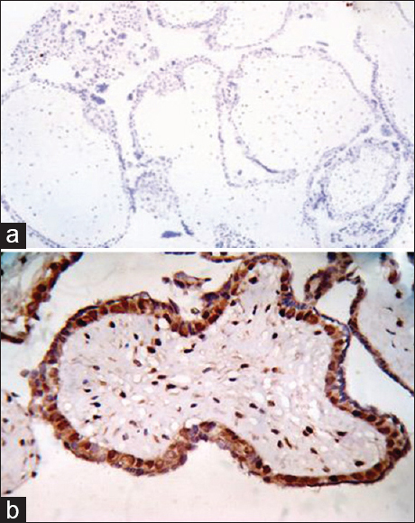 (a) Photomicrograph of complete mole showing complete absence of p57 immunostain in complete mole (H and E, ×100), (b) Photomicrograph of partial mole showing strong p57 positivity in villous cytotrophoblast as well as in the stromal cells (p57, ×400)