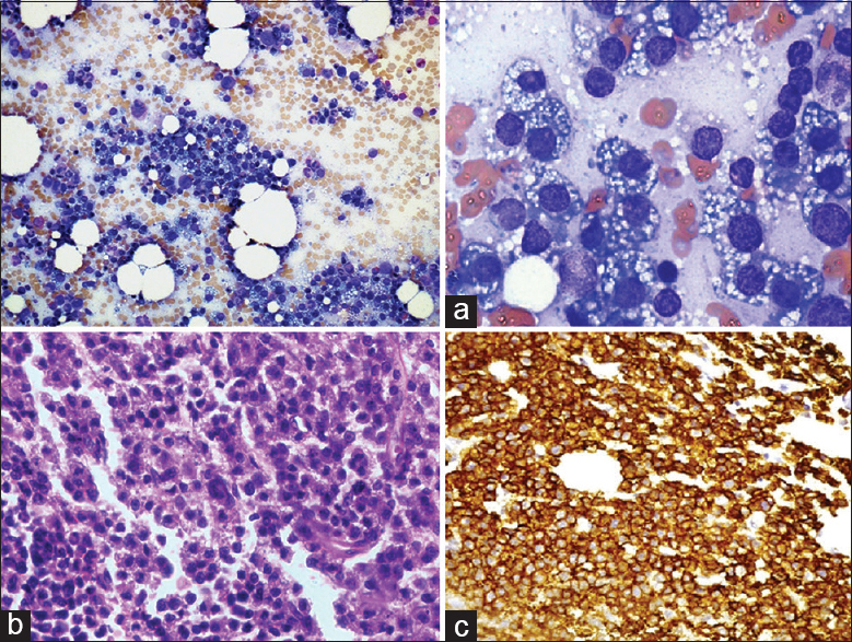 (a) Bone marrow aspirate smear, upper left image (×100) and upper right image (×400): Plasma cells with multiple clear cytoplasmic vacuoles seen throughout the aspirate (b) Lower left image (×400): Hypercellular marrow with diffuse involvement of vacuolated cells. (c) Lower right image (×400): IHC: CD138-positive plasma cells