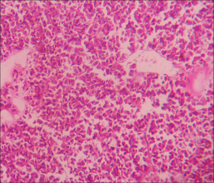 Eosinophilic adenoma (×400)
