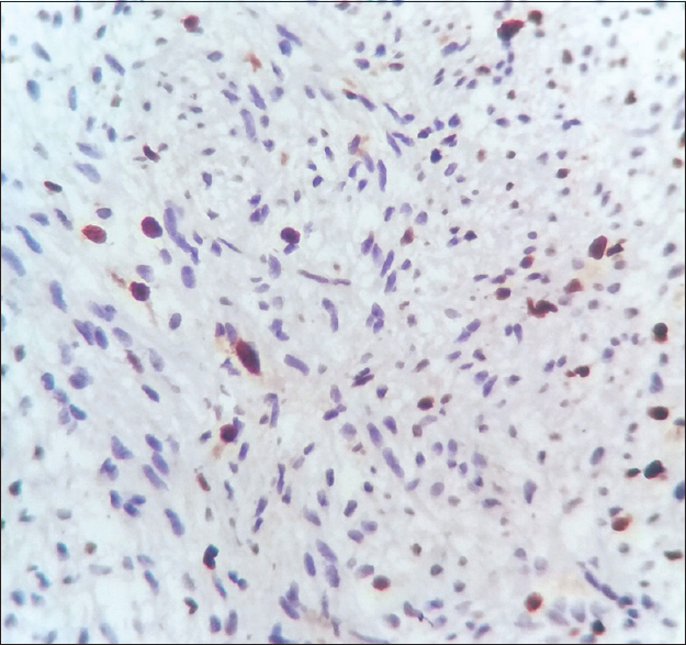 Nuclear expression of p53 immunostain in a case of borderline phyllodes tumors (×400)