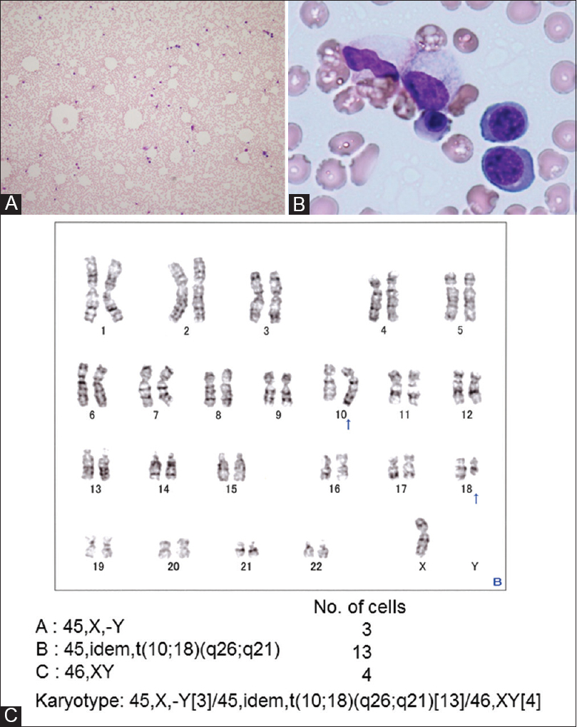 Morphological images of bone marrow aspirations at the initial diagnosis using Wright–Giemsa staining and a result of G-banding chromosomal analysis. (A) Morphological image with × 100 magnification. Hypocellular marrow with lipid droplets was observed. (B) Image at × 1000 magnification. No apparent dysplasia was observed. (C) A G-banded karyotype showing 45, X,-Y[3]/45, idem, t(10;18)(q26;q21)[13]/46,XY[4]. Arrows indicate translocated regions