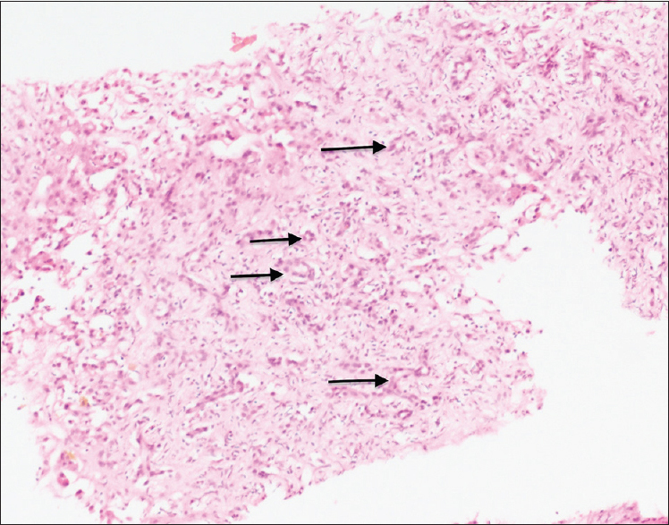 Proliferating benign bile ducts (H and E stain: ×10 × 10)