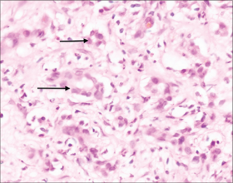 Ducts lined by columnar epithelium with minimal nuclear atypia (H and E stain: ×40 × 10)