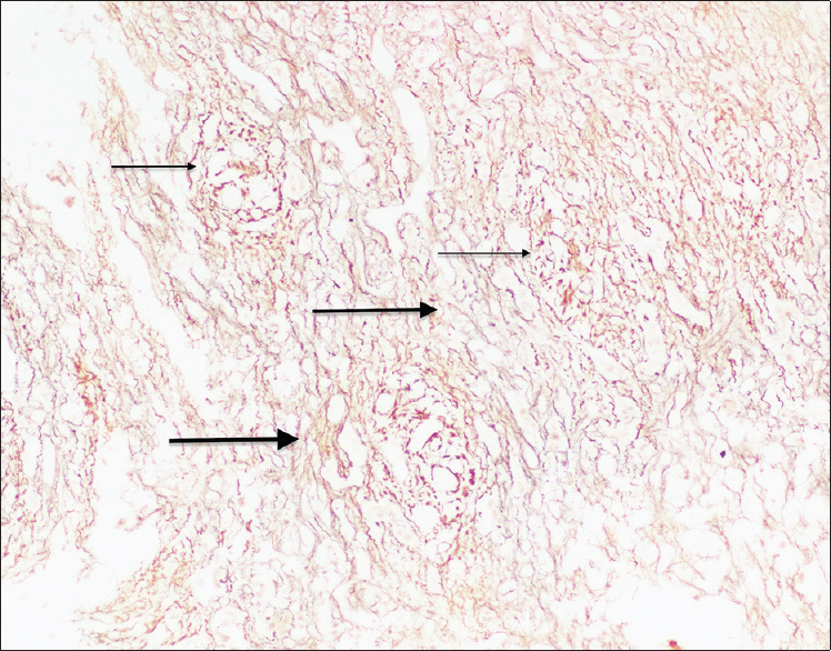 Increased fibrosis (thick arrow) around the benign bile ducts (thin arrow) (Reticulin stain: ×10 × 10)