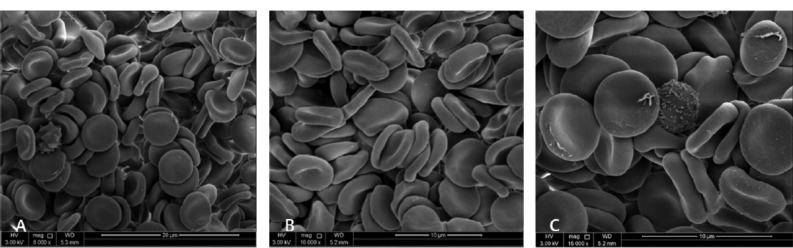 Low- and high-magnification of scan electron microscopy of RBCs from a blood bag on day 1 of blood donation collected in CPD-SAGM. The micrograph A-C with magnification 8,000× to 15,000×, respectively, shows cells are morphologically normal. Samples were prepared with packed RBC in buffered saline and fixed with 3% gulutraldehyde.