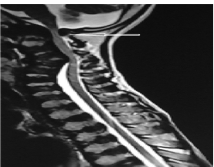 MRI whole spine- craniovertebral junction presenting compression at C1 level (arrow).
