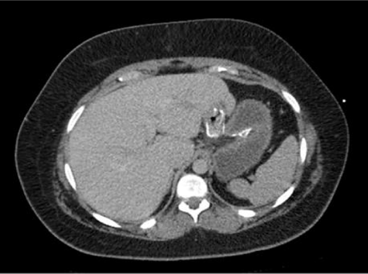 Post gastric bypass computed tomography (CT) abdomen pelvis with contrast, demonstrating gastrojejunal anastomosis intact following bariatric surgery.