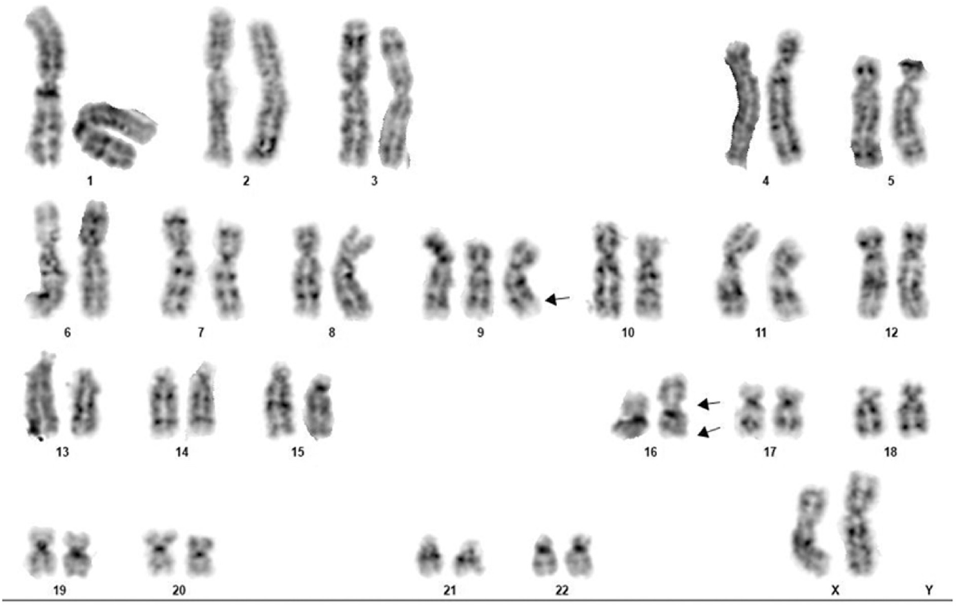 Conventional karyotype with GTG banding showing 47,XX, + 9,inv(16)(p13q22). Single arrow shows trisomy 9, double arrows indicate inv(16).