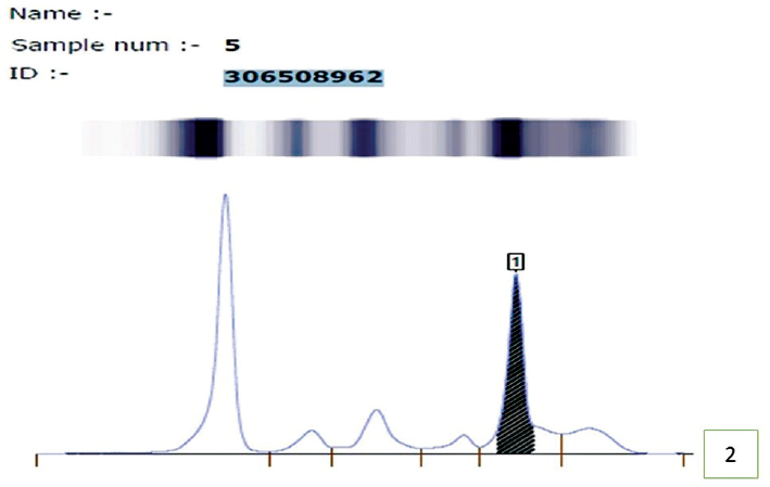 Serum protein electrophoresis showing M-spike in gamma globulin region suggesting monoclonal gammopathy.