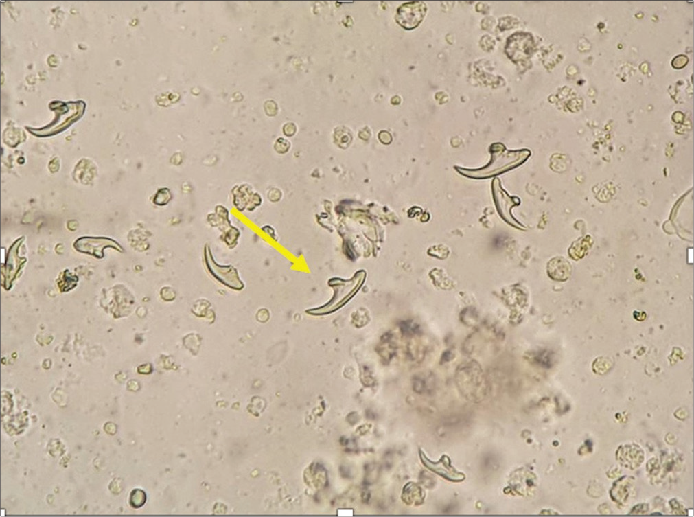 Photomicrograph (Wet mount microscopy) showing several hooklets (yellow arrow) of Echinococcus granulosus.