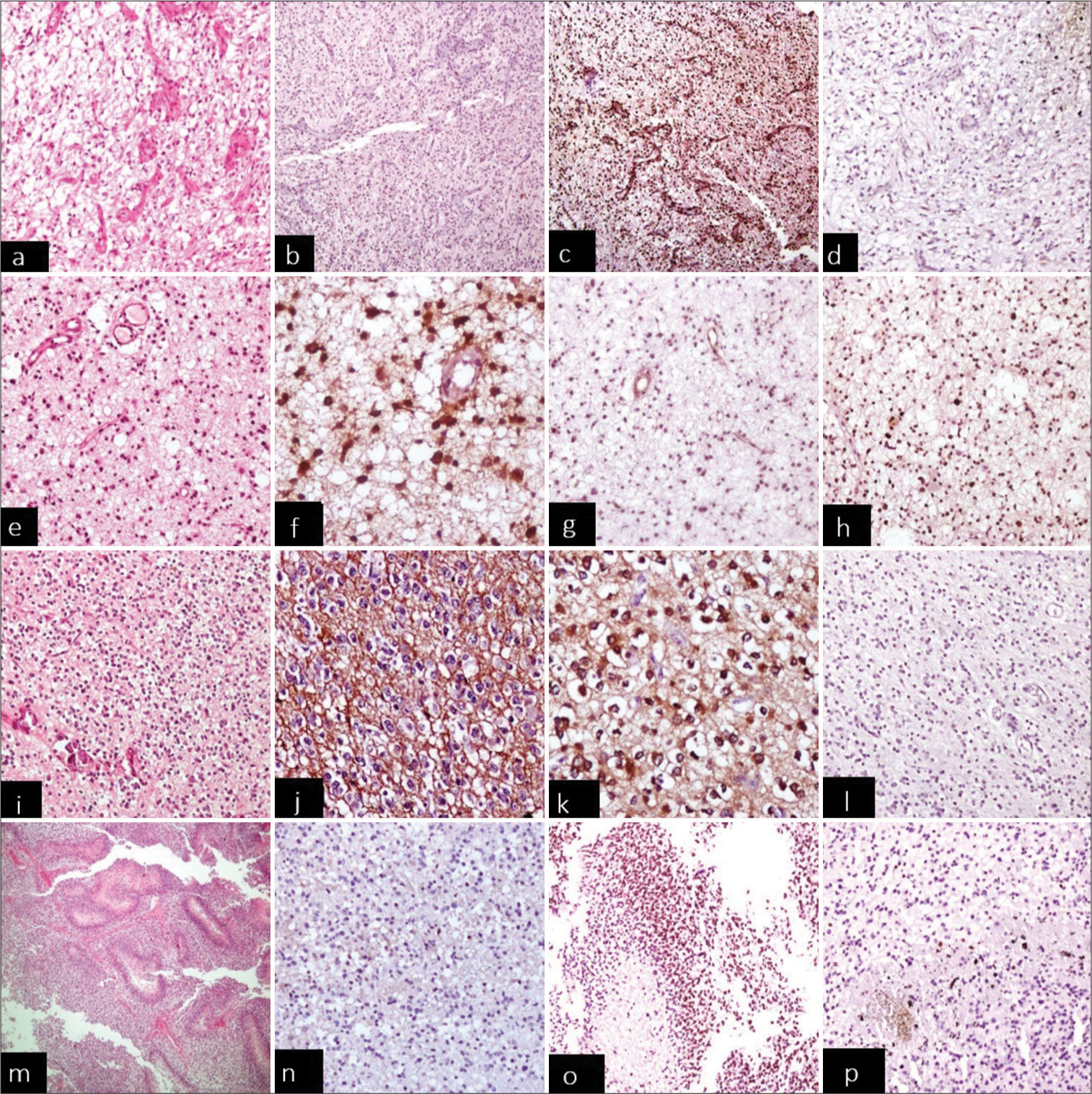 Surrogate immunohistochemistry (isocitrate dehydrogenase 1 [IDH-1], alpha-thalassemia mental retardation X-linked [ATRX], and P53) in gliomas. (a-d x40) Pilocytic astrocytoma: (a) H&E (b) absent IDH-1 (c) normal retained ATRX expression (d) absent P53. (e-h x40) Case of astrocytic phenotype grade 2: (e) H&E (f) positive immunostaining for IDH-1/IDH mutant (g) loss of nuclear ATRX expression while endothelial cells of blood vessels as internal control are positive (h) p53 overexpression. (i-l x40) Oligodendroglioma grade2: (i) H&E (j) IDH-1 positive/ mutant (k) retained nuclear ATRX expression/no loss (l) absent p53. (m-p x20) Primary glioblastoma: (m) H&E (n) Absent IDH-1 (o) retained nuclear ATRX expression (p) p53 negative. H&E: Hematoxylin and Eosin.