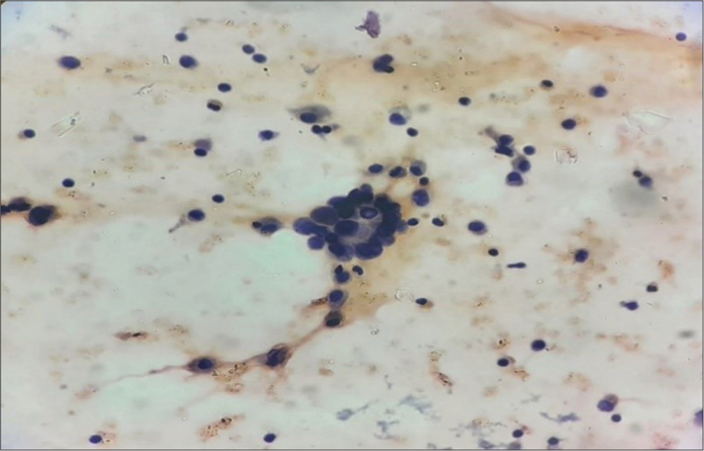 Atypical cells with follicular arrangement along with cyst macrophages in the cytosmears of fluid aspirated from the thyroglossal cyst (Papanicolaou stain, ×400).