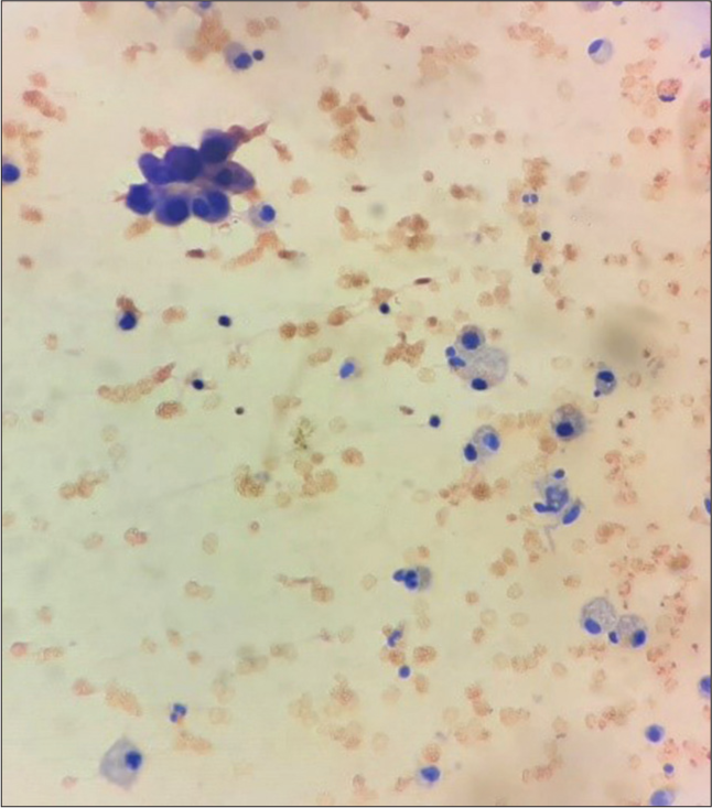 Showing papillary fragments along with cyst macrophages in the cytosmears of fluid aspirated from the thyroglossal cyst (PAP stain, 400×).