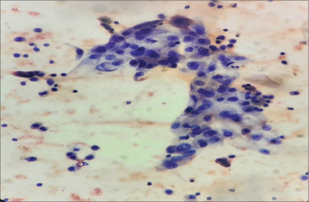 Sheet of atypical metaplastic cells along with cyst macrophages in the cytosmears of fluid aspirated from the thyroglossal cyst (Papanicolaou stain, ×400).