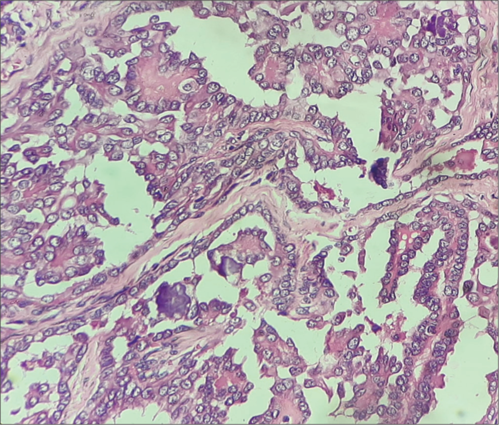 Features of papillary carcinoma of the thyroid (micro section of the received thyroglossal cyst specimen) (Hematoxylin and eosin, ×400).