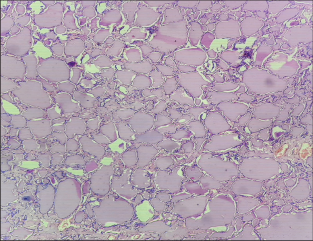 Variable-sized thyroid follicles filled with colloid (microsection of the received total thyroidectomy specimen) (Hematoxylin and eosin, ×400).