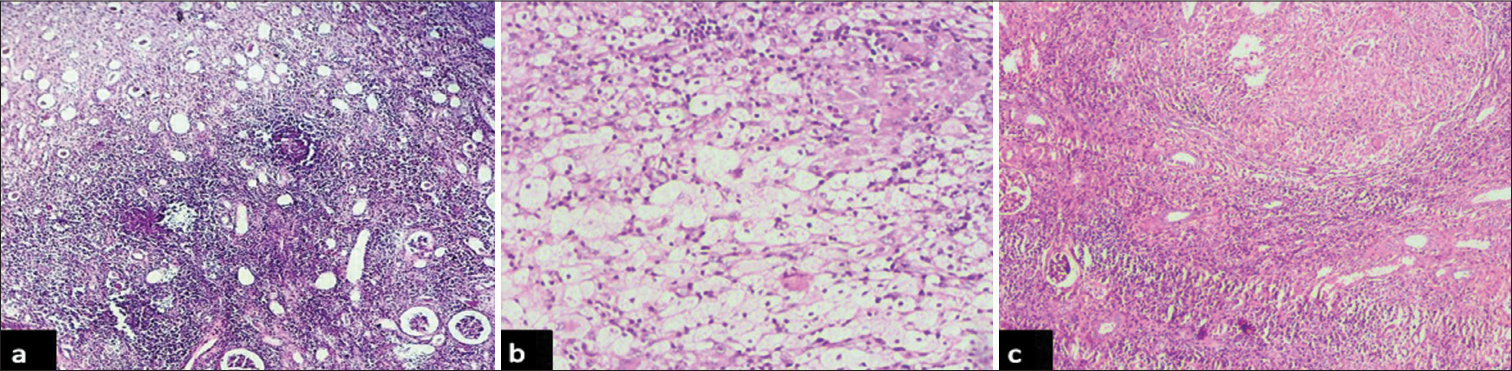 Photomicrographs of non – neoplastic lesions of kidney: (a) showing thyroidization of renal tubules, sclerotic blood vessels and interstitial inflammation- features consistent with Chronic pyelonephritis (hematoxylin and eosin, x4 objective lens), (b): showing structure of kidney infiltrated by xanthoma cells and chronic inflammatory infiltrate- features consistent with xanthogranulomatous pyelonephritis (hematoxylin and eosin, x40 objective lens), and (c) showing structure of kidney infiltrated by caseating granulomas with giant cells- features consistent with tuberculous pyelonephritis (hematoxylin and eosin, x4 objective lens).