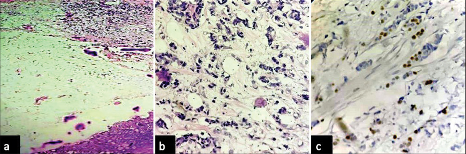 Photomicrographs of metastatic breast carcinoma: (a and b) showing renal parenchyma with metastatic deposit from breast carcinoma (hematoxylin and eosin, x4 and x40 objective lens respectively), and (c) showing tumor cells with nuclear positivity for estrogen receptor (diaminobenzidine, x40 objective lens).