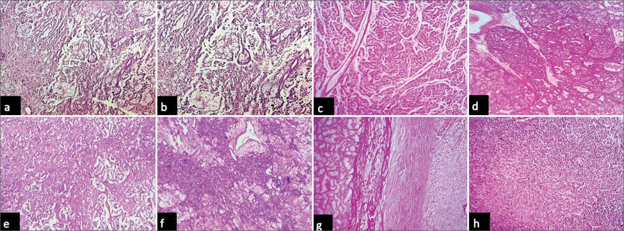 Photomicrographs: (a and b): of angiomyolipoma with myoid spindle cells, mature adipose tissue and blood vessels (hematoxylin and eosin, x4 and x10 objective lens respectively), (c and d): of metanephric adenoma composed of tumor cells arranged in tightly packed tubules and pseudopapillary patterns (hematoxylin and eosin, x10 and x40 objective lens respectively), (e and f): of adenomatoid tumor composed of tumor cells arranged in tubules, cords and focal angiomatoid patterns (hematoxylin and eosin, x4 and x40 objective lens respectively), and (g and h): of pheochromocytoma composed of tumor cells arranged in nesting patterns with adjacent normal looking renal tubules (hematoxylin and eosin, x4 and x40 objective lens respectively).