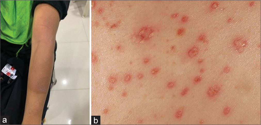 (a) Rifampicin induced Maculopapular rash (b) View of rash.